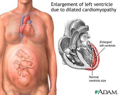 Peripartum cardiomyopathy Peripartum cardiomyopathy