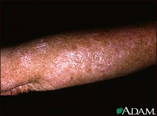 Actinic keratosis on the arm Actinic keratosis on the arm