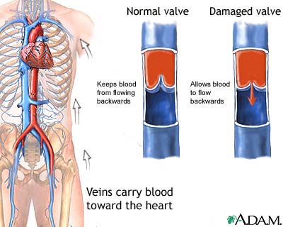Venous insufficiency Venous insufficiency