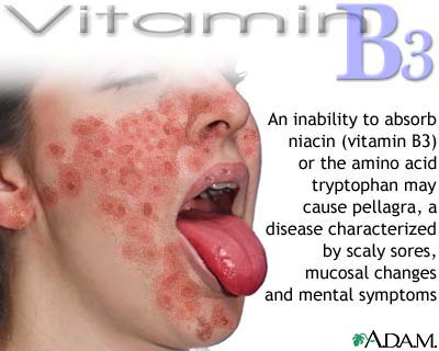 Vitamin B3 deficit Vitamin B3 deficit