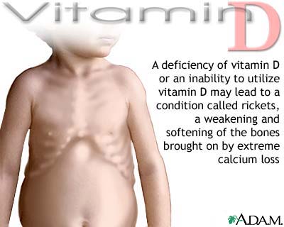 Vitamin D deficit Vitamin D deficit