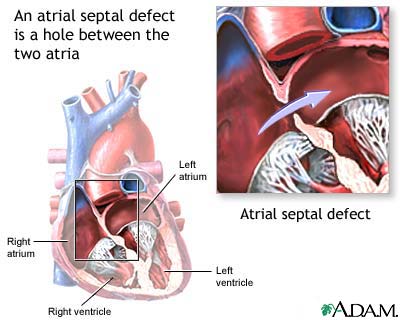Atrial septal defect Atrial septal defect