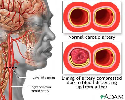Carotid dissection Carotid dissection