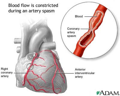 Coronary artery spasm Coronary artery spasm