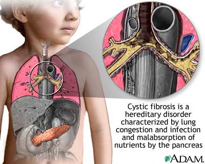 Cystic fibrosis Cystic fibrosis
