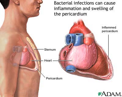 Bacterial pericarditis Bacterial pericarditis