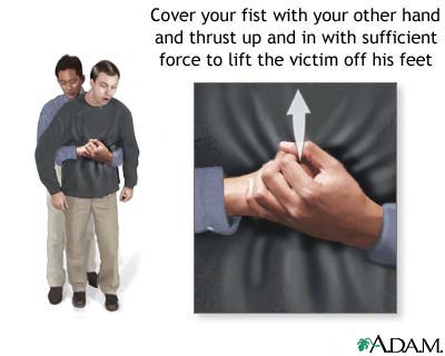 Heimlich maneuver on an adult Heimlich maneuver on an adult