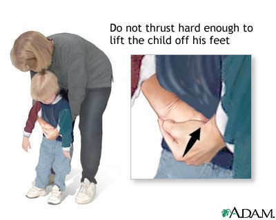 Heimlich maneuver on conscious child Heimlich maneuver on conscious child