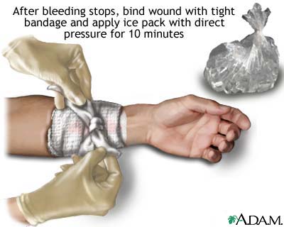 Stopping bleeding with pressure and ice Stopping bleeding with pressure and ice