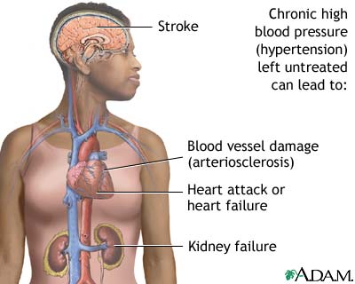 Untreated hypertension Untreated hypertension