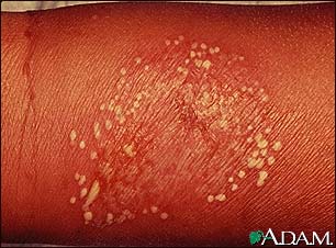 Pustules, superficial on the arm Pustules, superficial on the arm