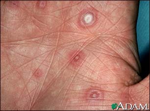 Erythema multiforme, target lesions on the palm Erythema multiforme, target lesions on the palm