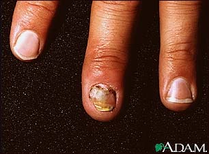 Nail infection, candidal Nail infection, candidal