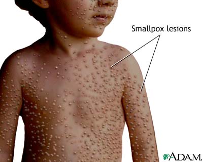 Smallpox lesions Smallpox lesions