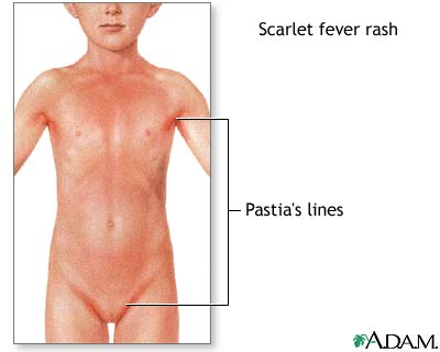 Signs of scarlet fever Signs of scarlet fever