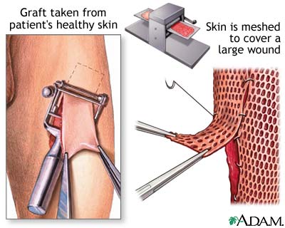 Skin graft Skin graft
