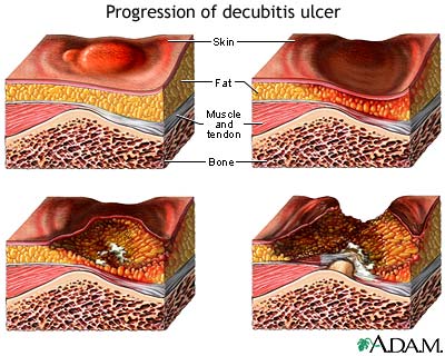 Progression of a decubitis ulcer Progression of a decubitis ulcer