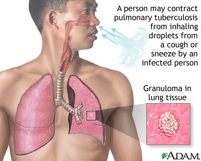 Tuberculosis of the lungs