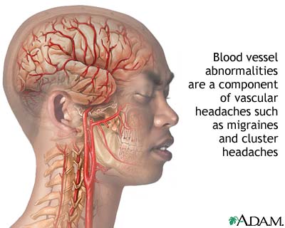 Vascular headaches Vascular headaches