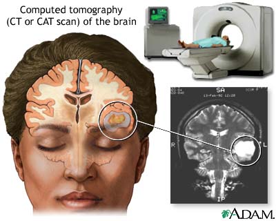 CT scan of the brain CT scan of the brain