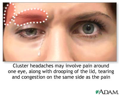 Pain of cluster headache Pain of cluster headache