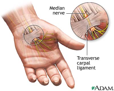 Compression of the median nerve Compression of the median nerve