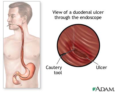 Gastroscopy procedure Gastroscopy procedure