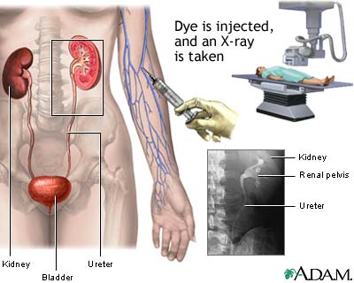 Intravenous pyelogram (IVP) Intravenous pyelogram (IVP)