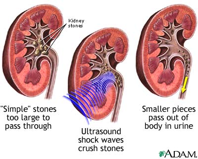 Lithotripsy procedure Lithotripsy procedure