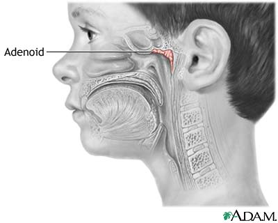 Adenoids Adenoids