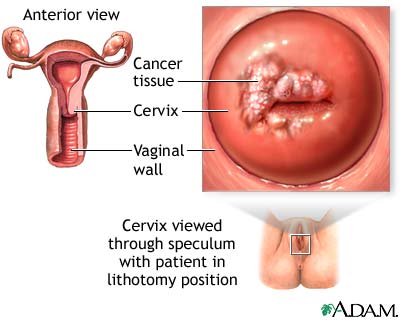 Cervical cancer Cervical cancer
