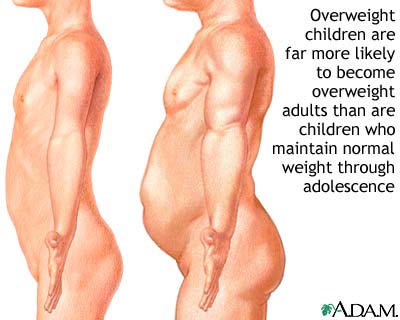 Childhood obesity Childhood obesity