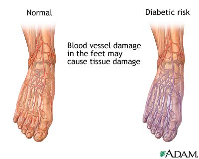 Diabetic blood circulation in foot Diabetic blood circulation in foot