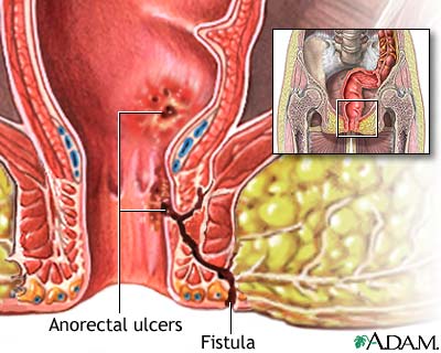 Anorectal fistulas Anorectal fistulas