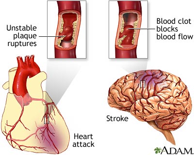 Plaque buildup in arteries Plaque buildup in arteries