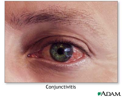 Conjunctivitis Conjunctivitis