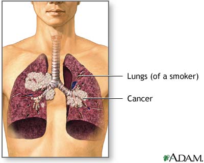 Secondhand Smoke and Lung Cancer Secondhand Smoke and Lung Cancer