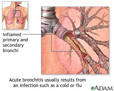 Cause of Acute Bronchitis Cause of Acute Bronchitis
