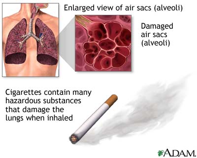 Smoking and COPD (Chronic Obstructive Pulmonary Disorder) Smoking and COPD (Chronic Obstructive Pulmonary Disorder)