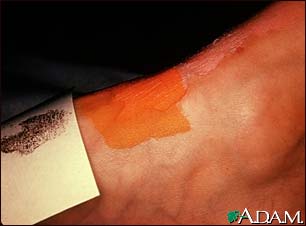 Sweat Test Sweat Test