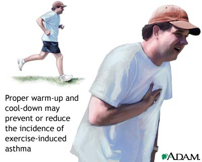 Exercise-induced asthma Exercise-induced asthma