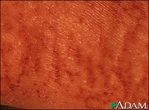 Xerosis - close-up Xerosis - close-up