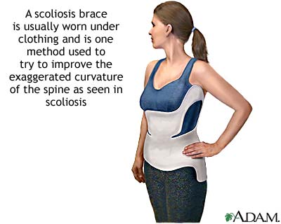 Scoliosis brace Scoliosis brace
