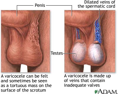 Varicocele Varicocele