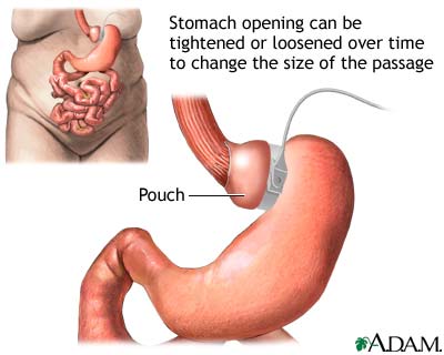 Adjustable gastric banding Adjustable gastric banding