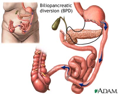 Biliopancreatic diversion (BPD) Biliopancreatic diversion (BPD)