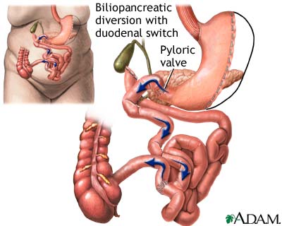Biliopancreatic diversion with duodenal switch Biliopancreatic diversion with duodenal switch