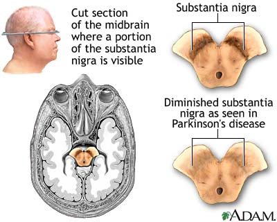 Substantia nigra and Parkinson's disease Substantia nigra and Parkinson's disease
