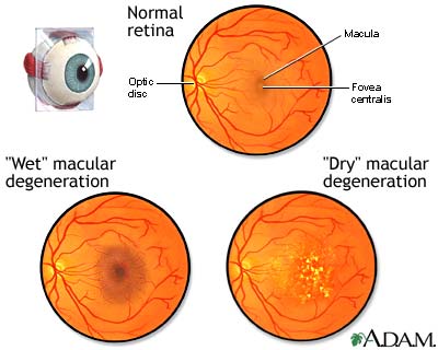 Macular degeneration Macular degeneration