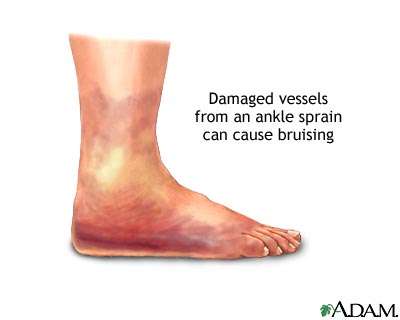 Ankle sprain swelling Ankle sprain swelling